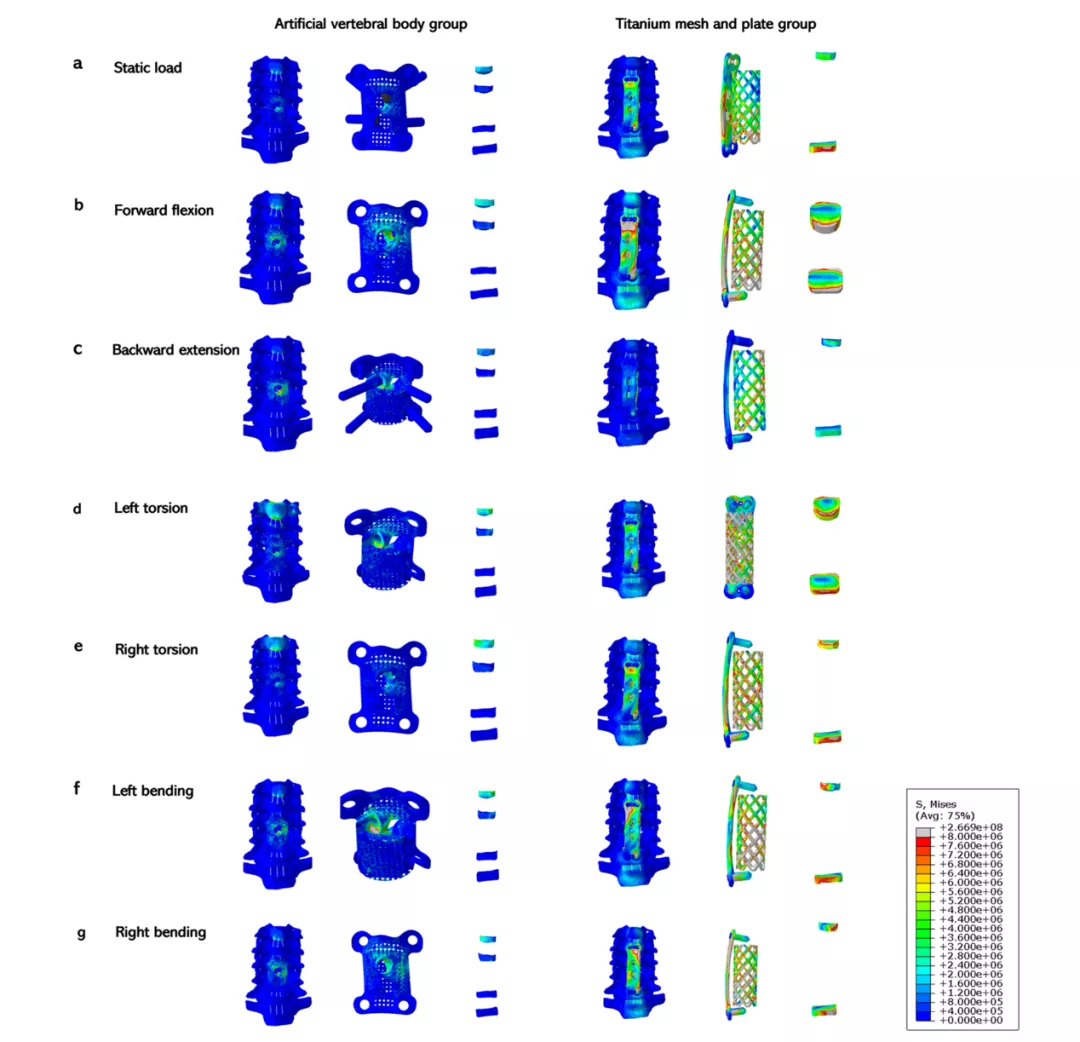 3D打印助力骨科精准临床应用：临床案例解析