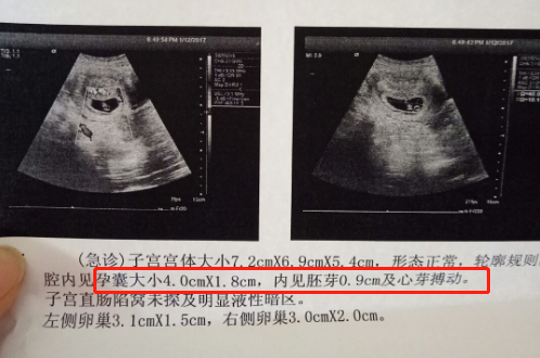 前面也說了,孕5-8周是胚胎形成胎兒的重要時期,這個階段胎兒的器官