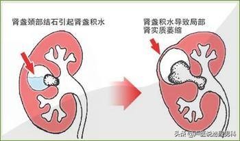 如果你患有尿路结石，准备通过“体外冲击波碎石”治疗，请看此文