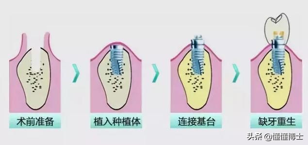 种植牙、烤瓷牙和镶牙哪个好？一起来说说牙齿那些事