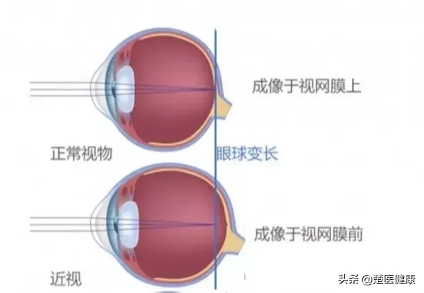 公立医院眼科医生揭秘:近视激光手术到底靠不靠谱