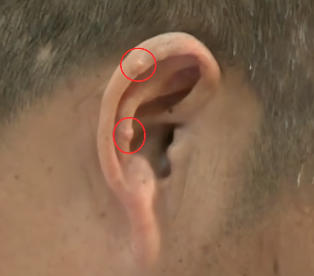 "亡羊补牢"治痛风石也不晚,因时制宜选择保守治疗,微创手术