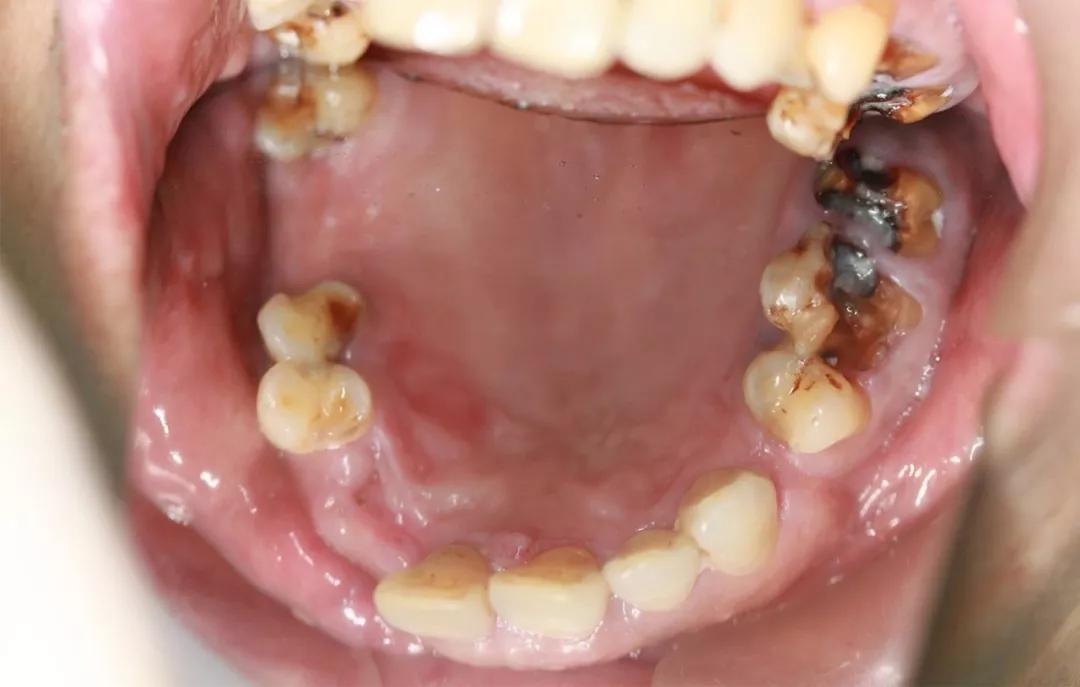 成年人有多少颗牙齿(研究发现) - 青木春