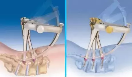 SEXTANT Ⅱ经皮椎弓根螺钉系统