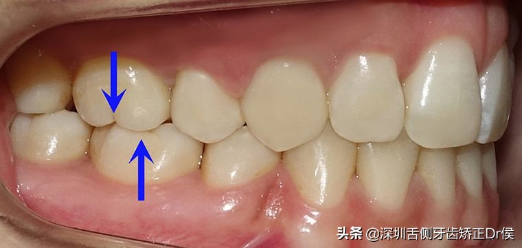 深圳牙科醫院是如何治療牙齒咬合紊亂的?