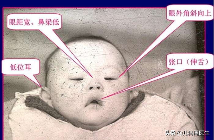 科学家将其称之为21三体综合症,它是人类最早被确定的染色体异常疾病