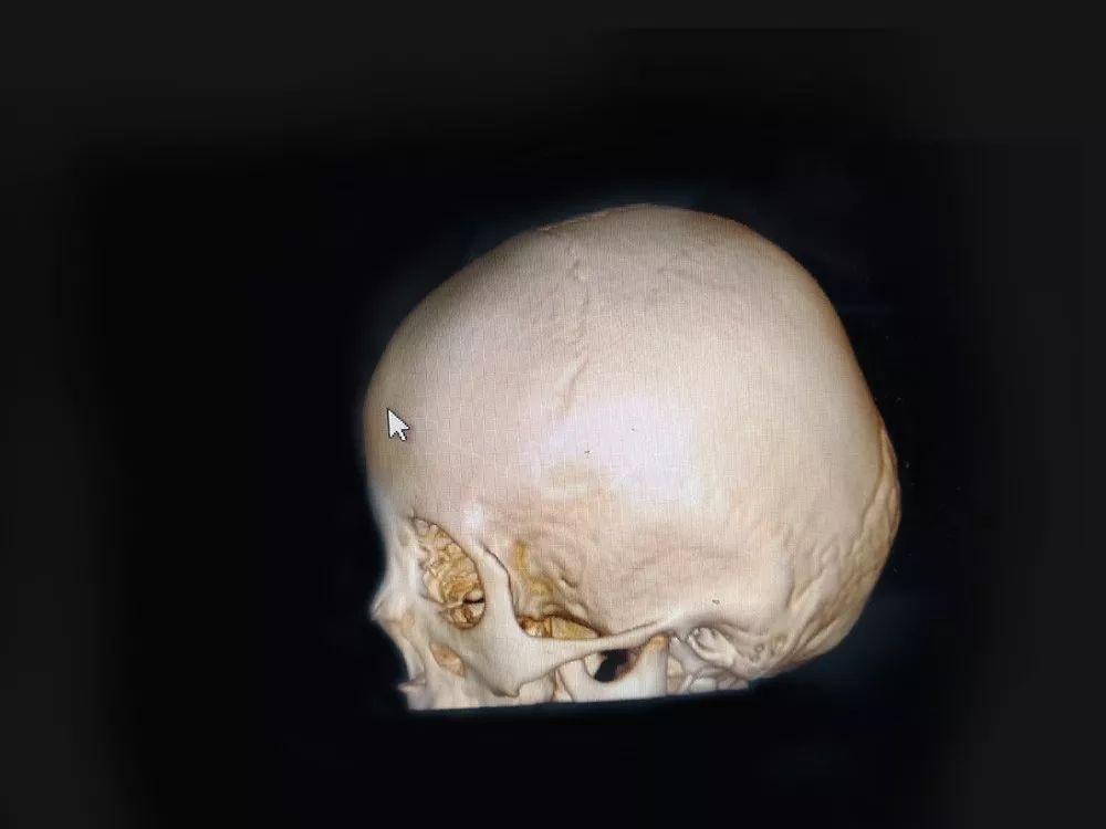 婴儿人字缝闭合时间(尖头娃娃) - 乐宝宝贝