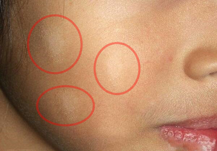 还是白癜风?家长莫慌,可能白色糠疹在作怪