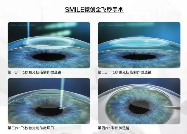 近视激光手术有几种?有风险和后遗症吗?医生很少会告诉你