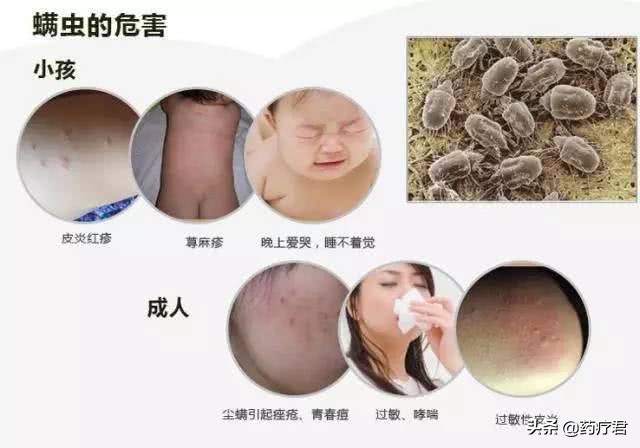 螨虫叮咬后的症状图(这个东西，让3岁的宝宝起了满身红疹，家家都有)