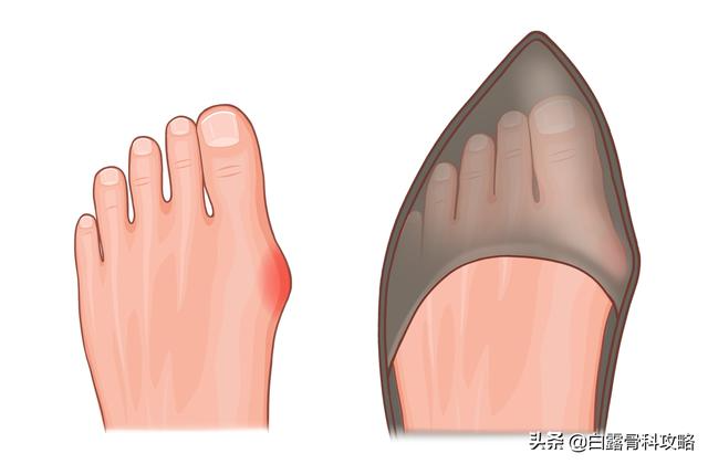 辟谣：我得了拇外翻一定要手术？不一定
