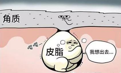 闭口粉刺如何祛除？