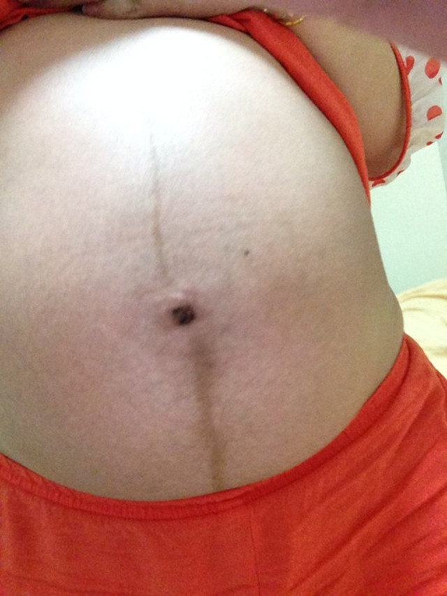 怀孕后肚皮上长“黑线”？准妈妈别苦恼，做好4件事有利于恢复