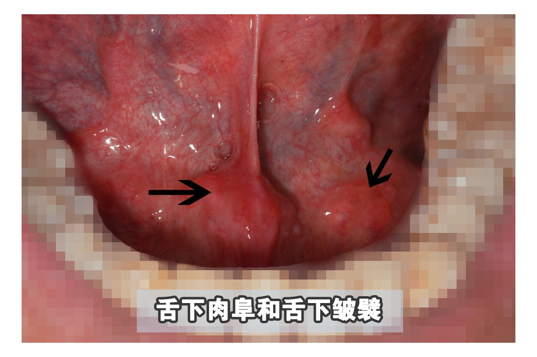 嘴里长肉疙瘩怎么办？牙齿旁边出现可怕肿块的处理方法
