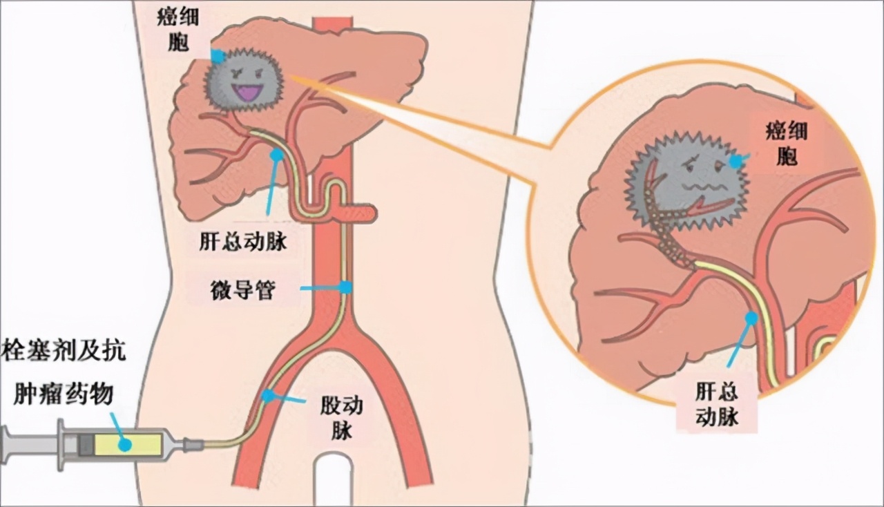 肝功能正常，半年后查出肝癌晚期？医生：筛查肝癌这3项检查别省