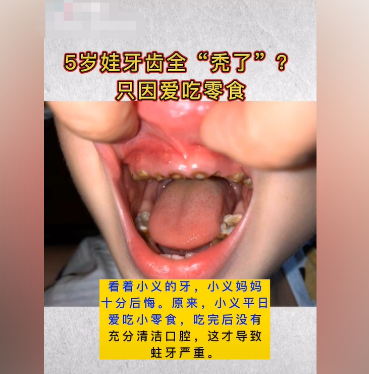 5岁孩子牙齿“秃了”，爱吃零食加上妈妈“懒”引起，后悔都迟了