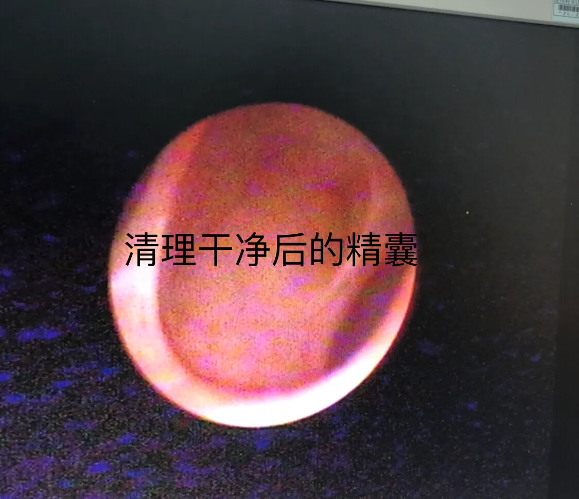 男科手术探秘6:精囊炎血精、精囊结石和精囊镜手术、钬激光碎石