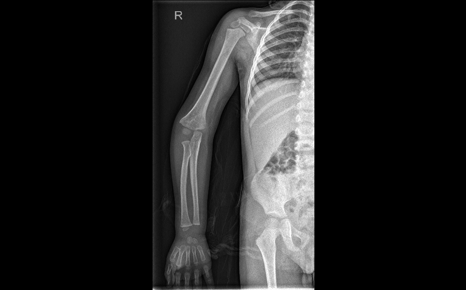 骨科医生：如果孩子手臂不太直，符合以下情况的需要治疗