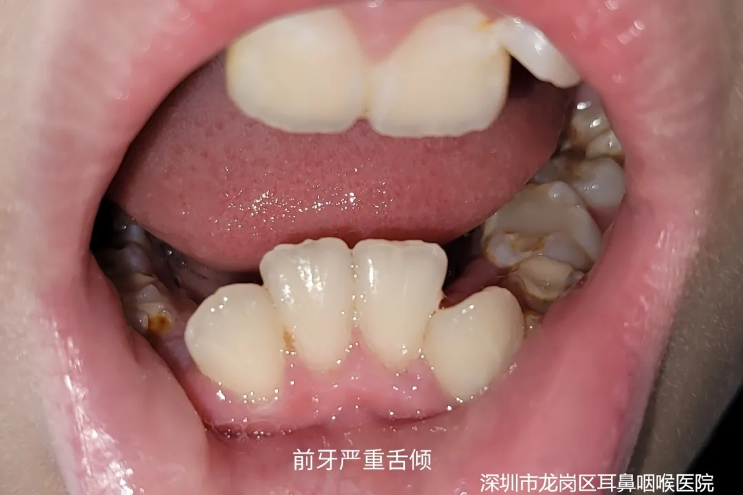 所以,家长发现孩子频频张口呼吸,或是变"丑"了,不要自己瞎买买买,让各