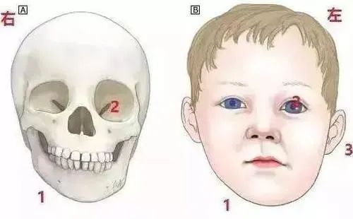 还有一种是下颌骨头发育不对称造成的骨性问题,这就要去医院正颌科拍