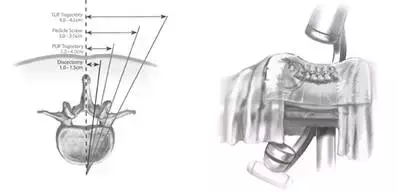 SEXTANT Ⅱ经皮椎弓根螺钉系统