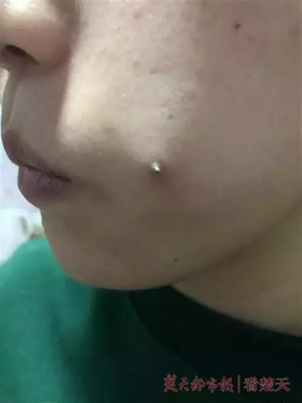 19岁女孩自愿在脸上打2颗钢钉,目的让人无法理解