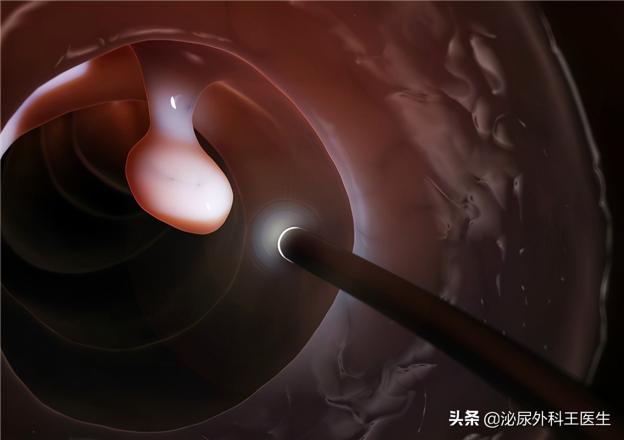 一天3、4次大便，便血5个月，男子查出肠癌晚期：有病不能拖