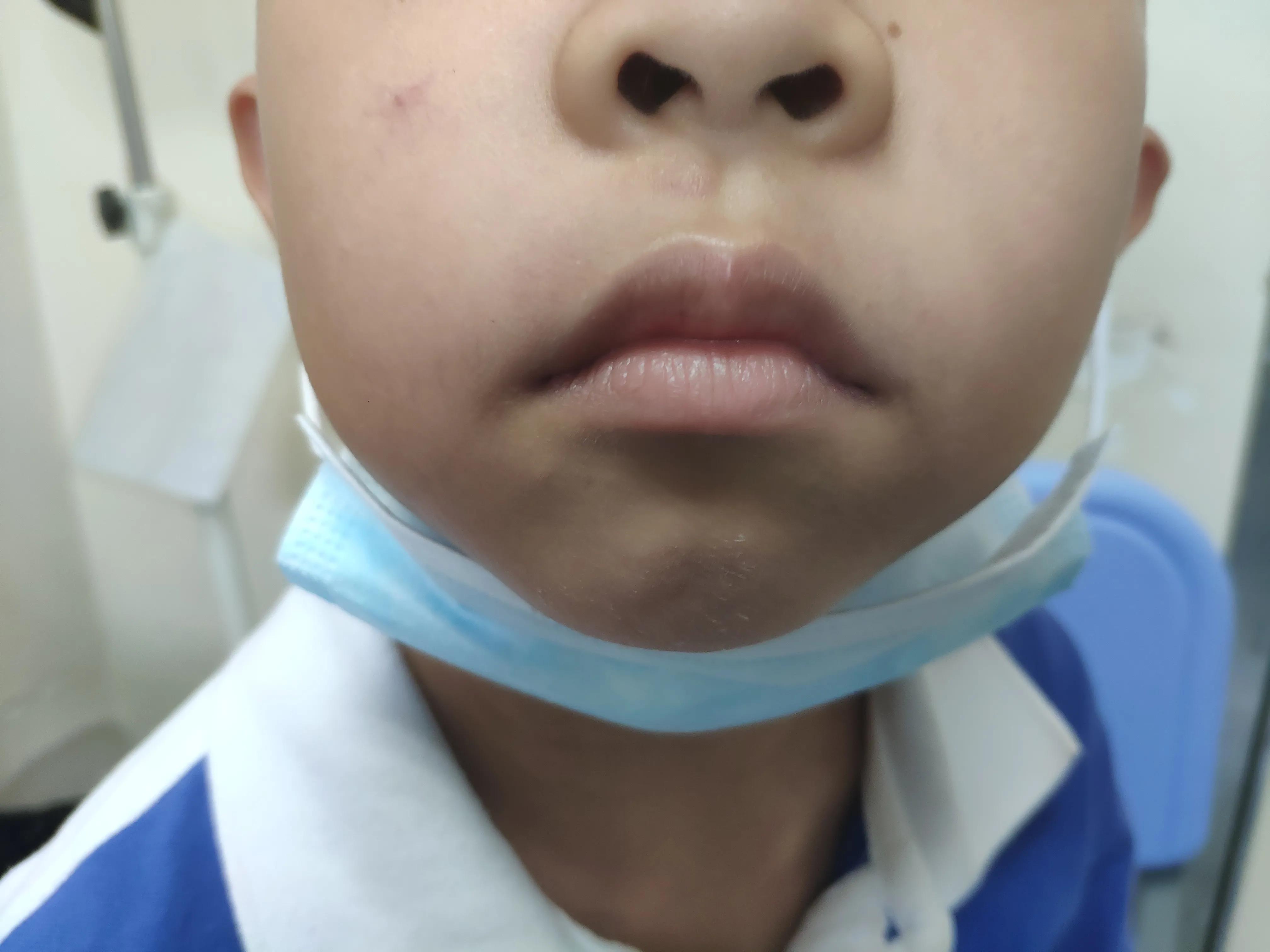 腺样体容貌(腺样体肥大面容照片)