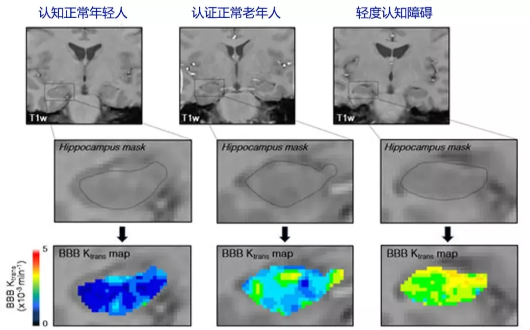 「直观明了」用图解释阿尔兹海默病的发病机制