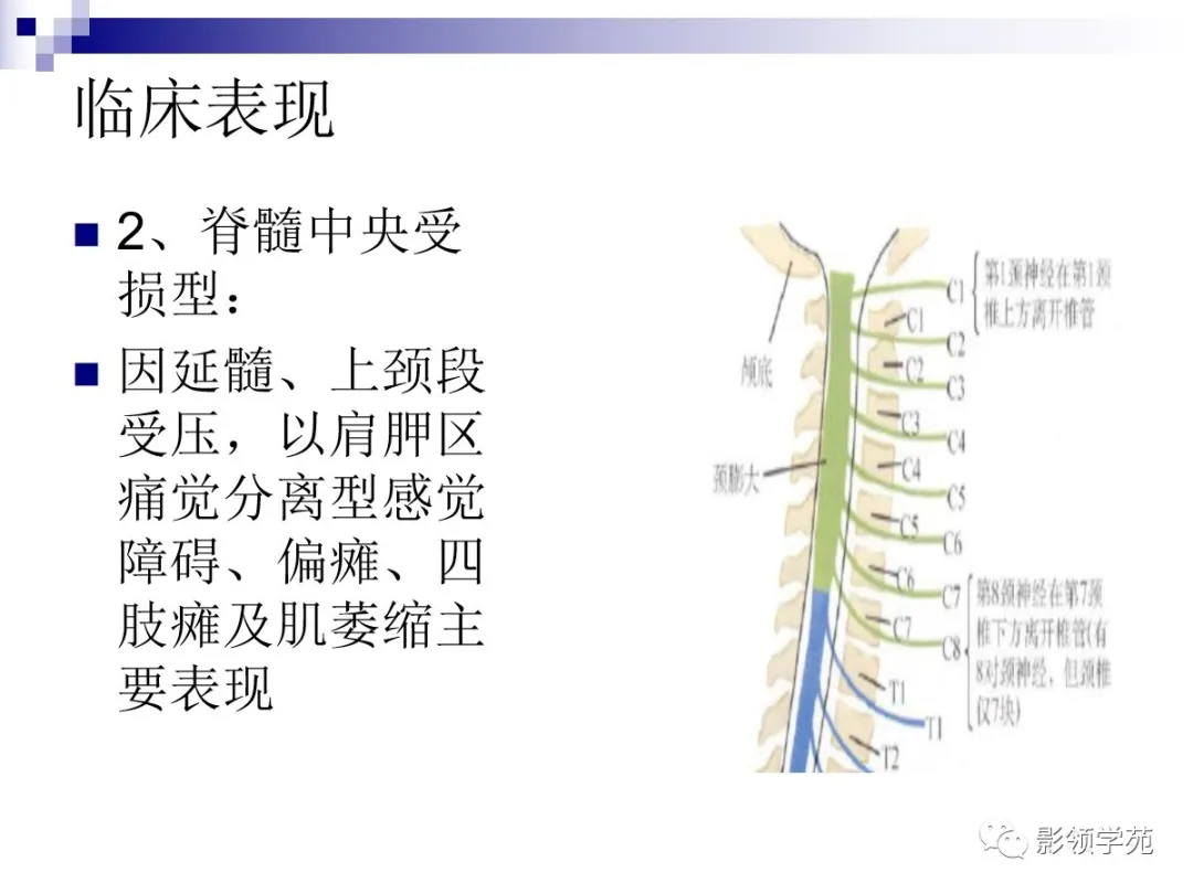 小脑扁桃体下疝畸形概述