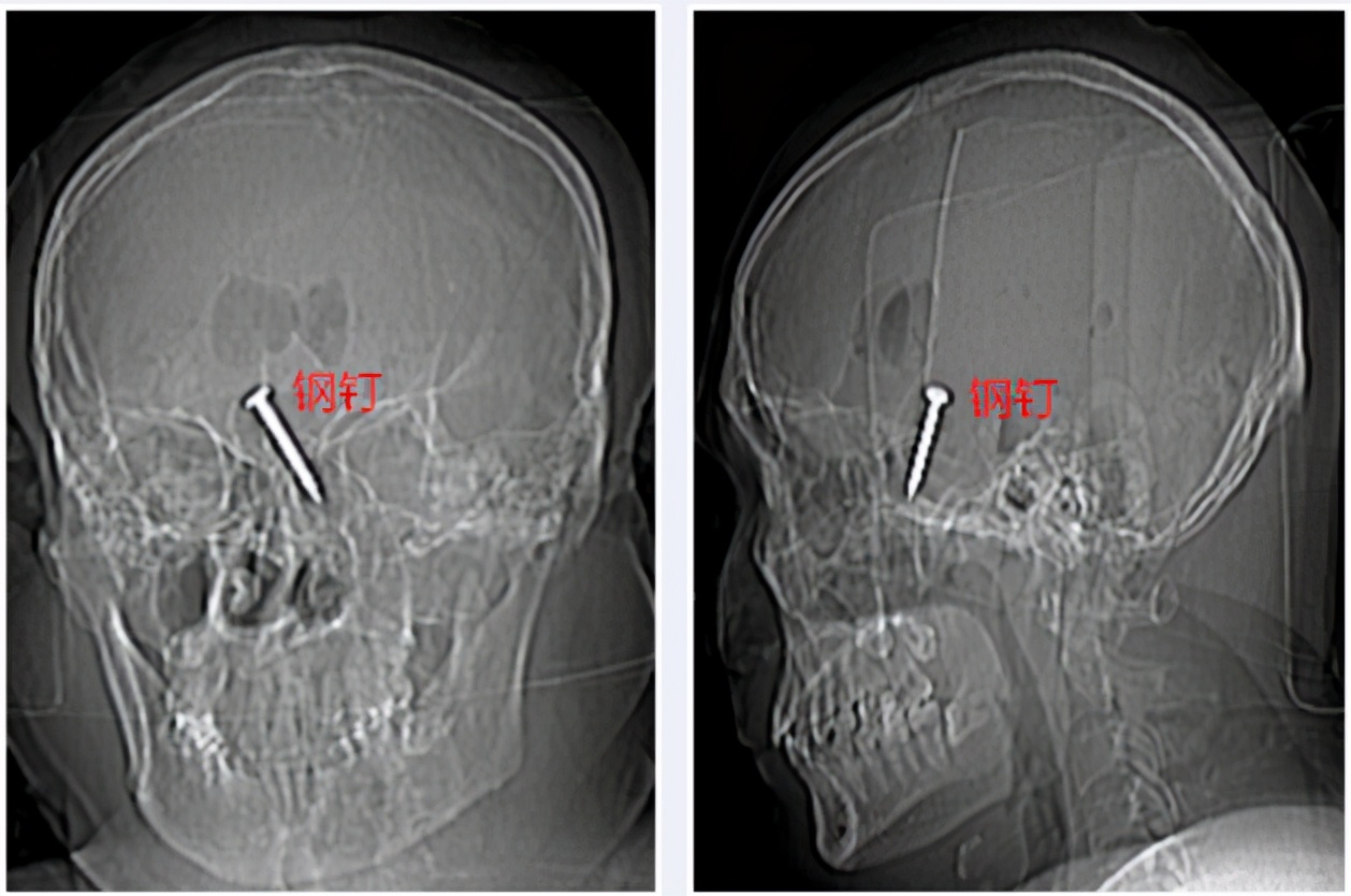 钢钉入脑 幸遇良医 —— 潞河医院神经外科抢救钢钉入脑患者的真实故事
