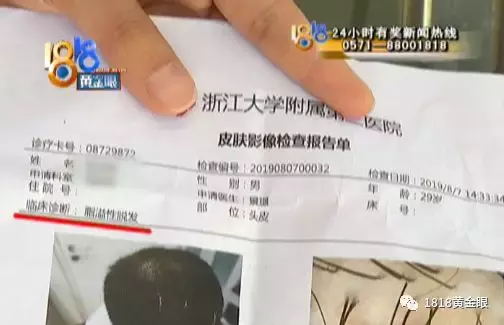 小伙花了几万植发,发痒,还掉头发