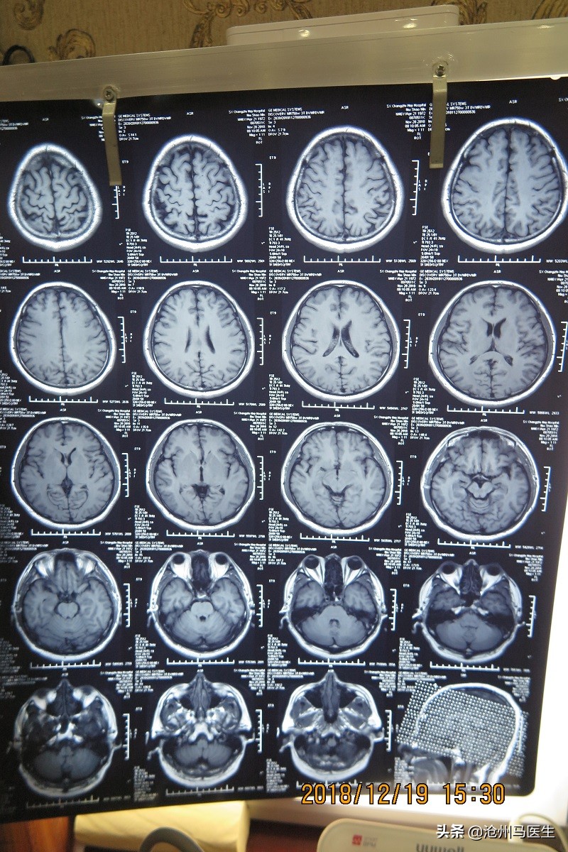 天旋地转，眩晕恶心、呕吐、心慌的中医治疗病例报告分析