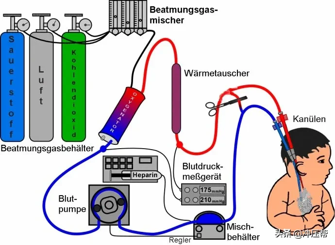 救命的人工肺（ECMO），为什么还没有国产化？