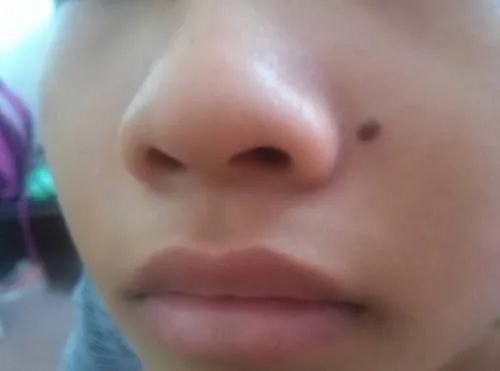 点痣图片(孩子脸上长)