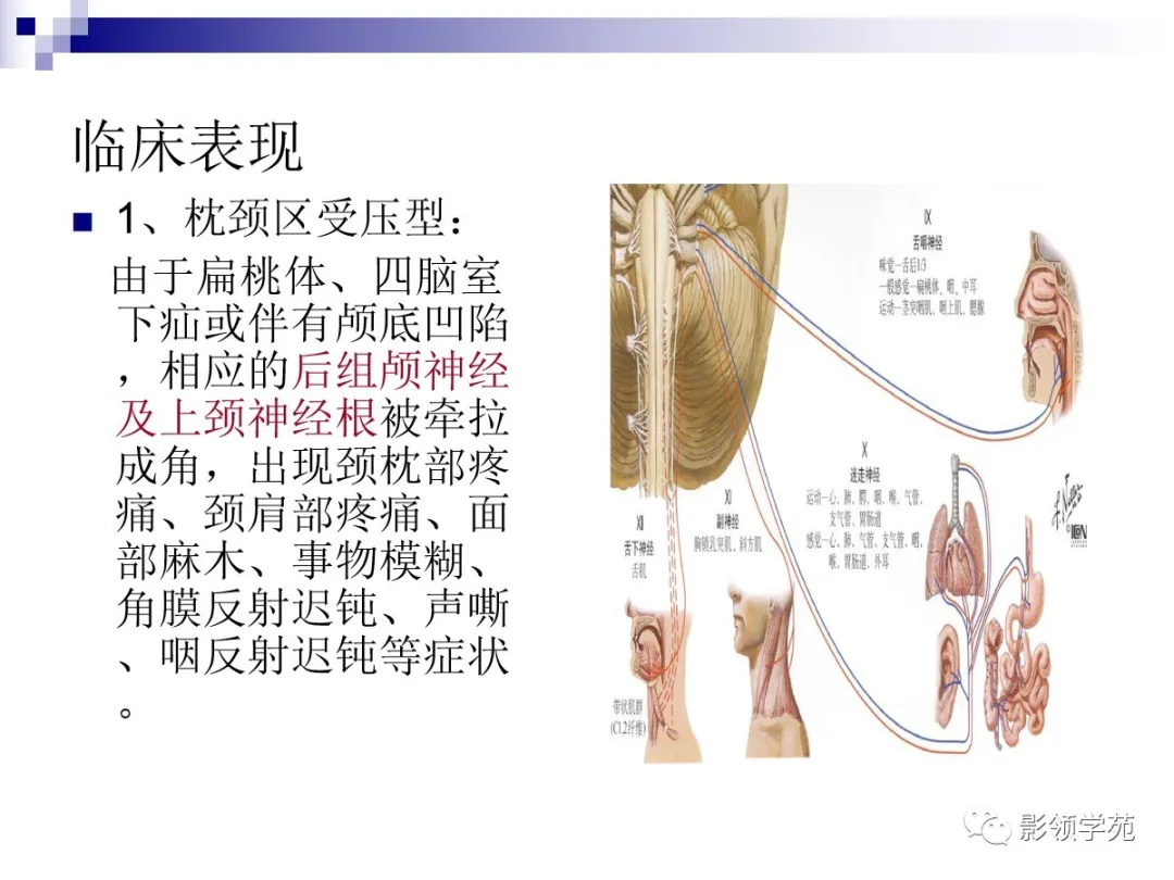 小脑扁桃体下疝畸形概述