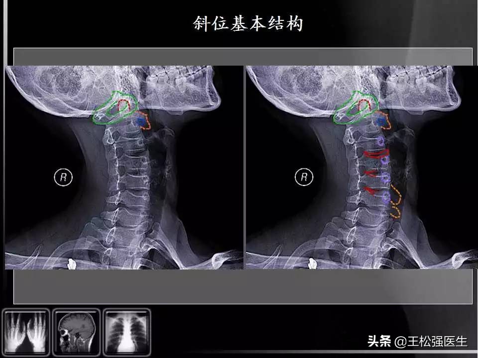 颈椎X光片