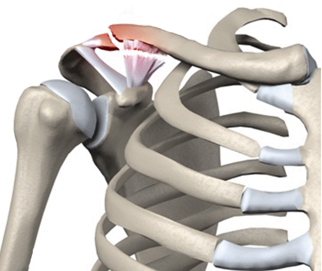 锁骨骨折怎么办?