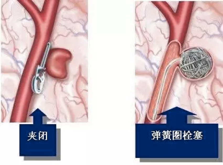 什么是脑动脉瘤？有哪些症状？医生提醒：要控制危险因素