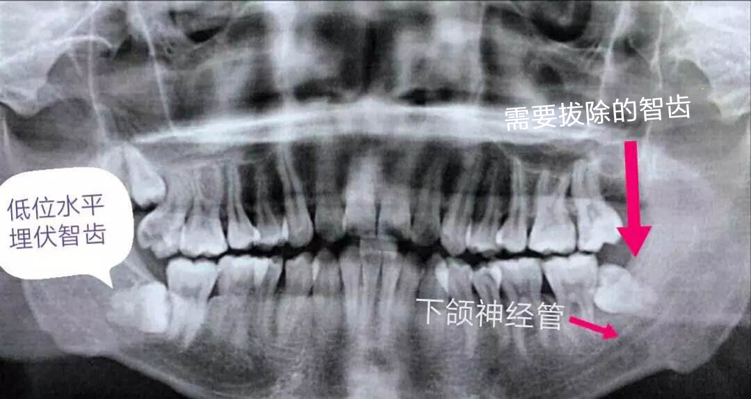 为什么别人拔智齿200，我拔就要2000？我是被坑了吗？