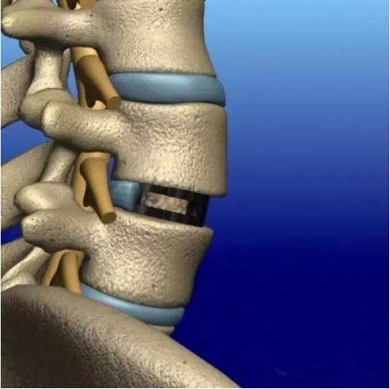 腰椎疾病、腰椎间盘突出你想知道的事全集！