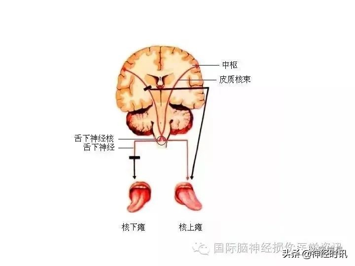 十二对颅神经解剖及损伤后表现