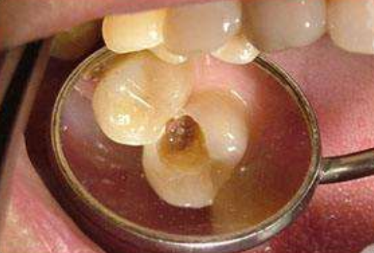 牙齿龋坏后需补牙，补牙材料选哪种好？牙医教你选便宜又好用的