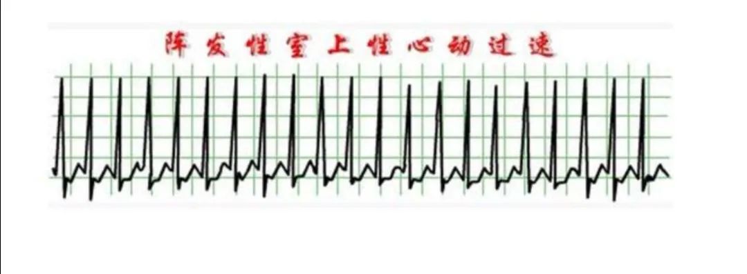 1份30元的心电图，可直接诊断出5种常见心脏病，辅助诊断4种病