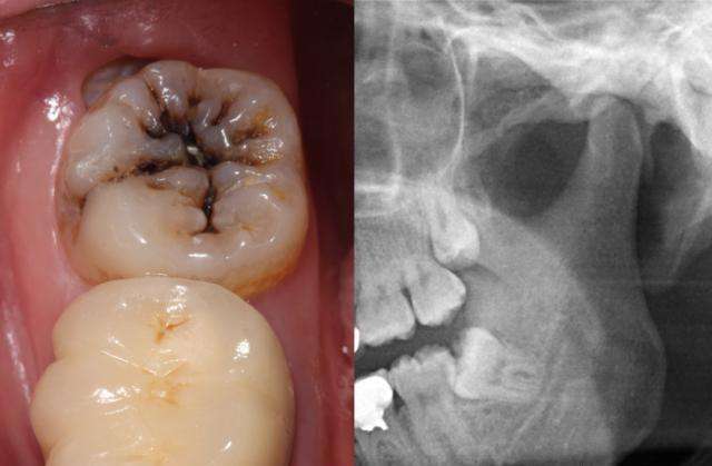 当智齿碰上急性牙髓炎，是直接拔除还是开髓后拔除？#雅悦齿科#
