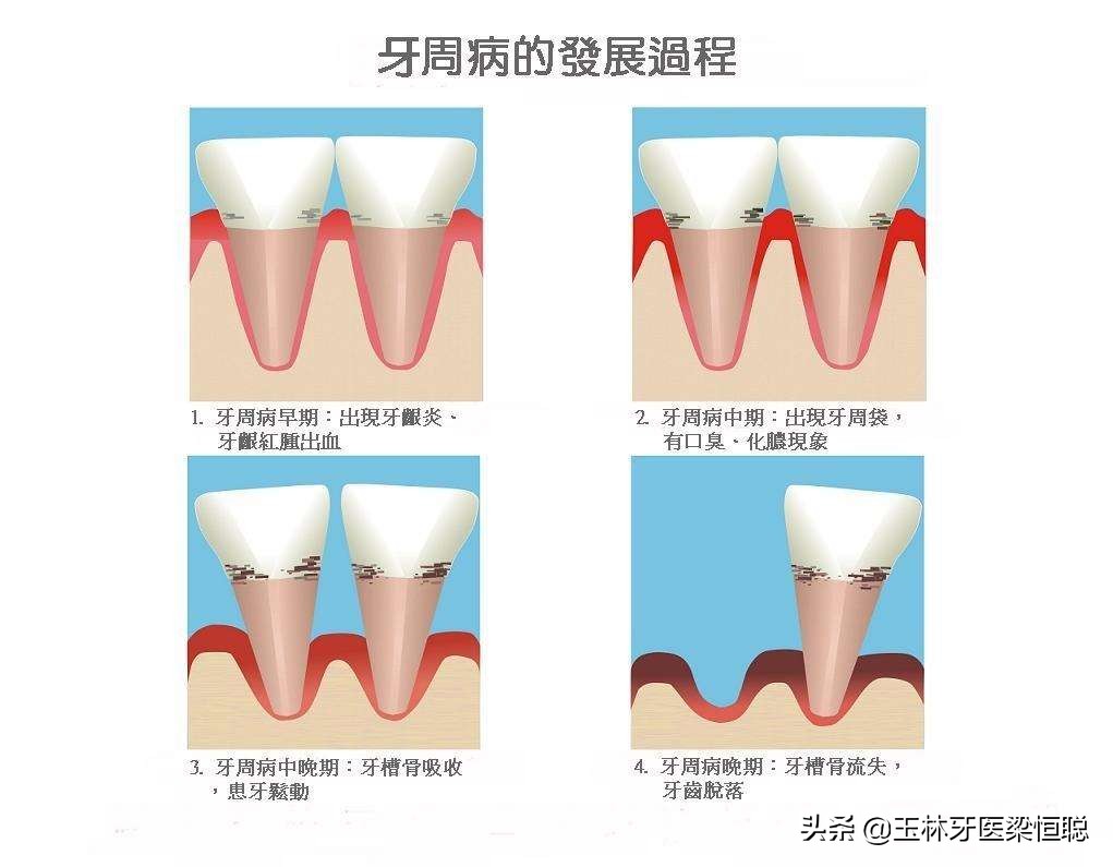 牙龈红肿、出血是怎么回事？