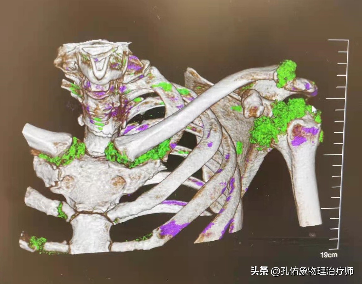 手指肿胀、僵硬、疼痛、有结节，挺挺就过去了？辟谣，趁早诊治