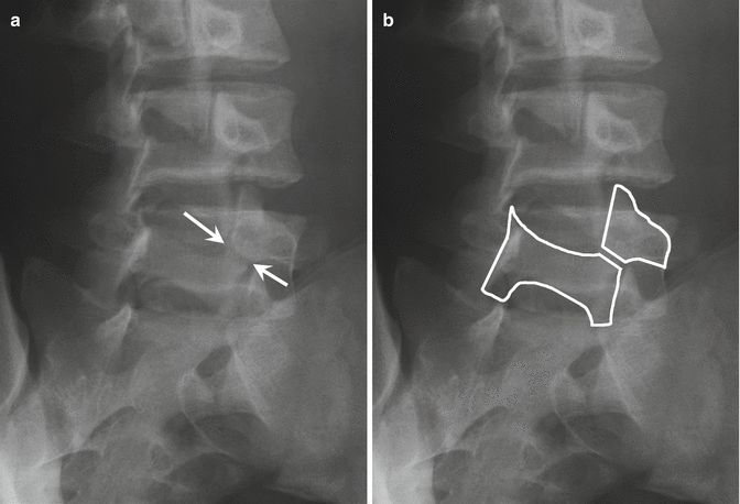 从诊断到治疗：全面解析腰椎峡部裂(lumbar spondylolysis)