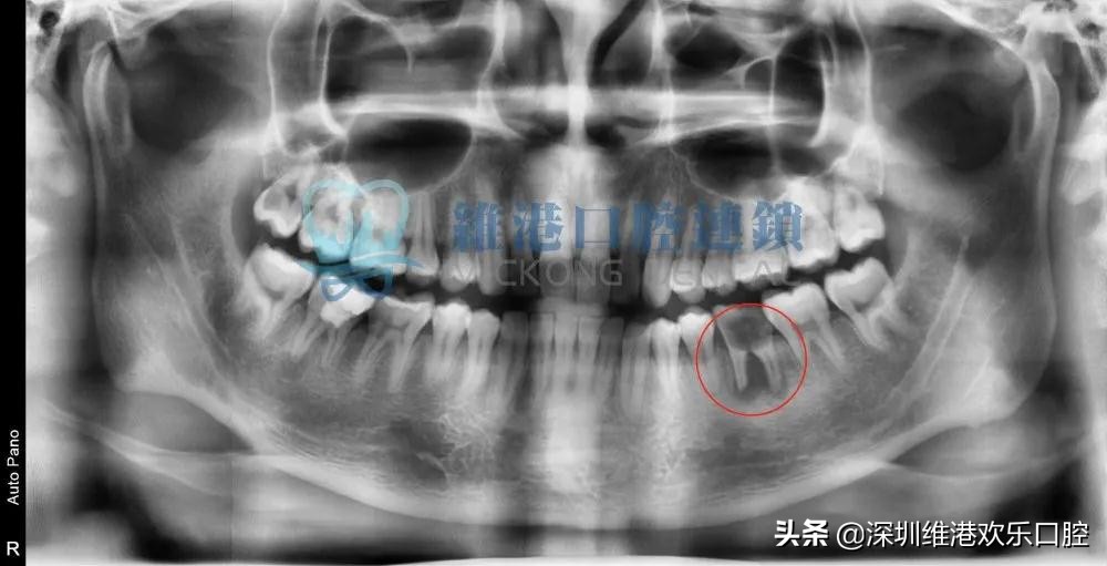 根尖囊肿免费公益筛查，防止牙槽骨破坏和脸部畸形