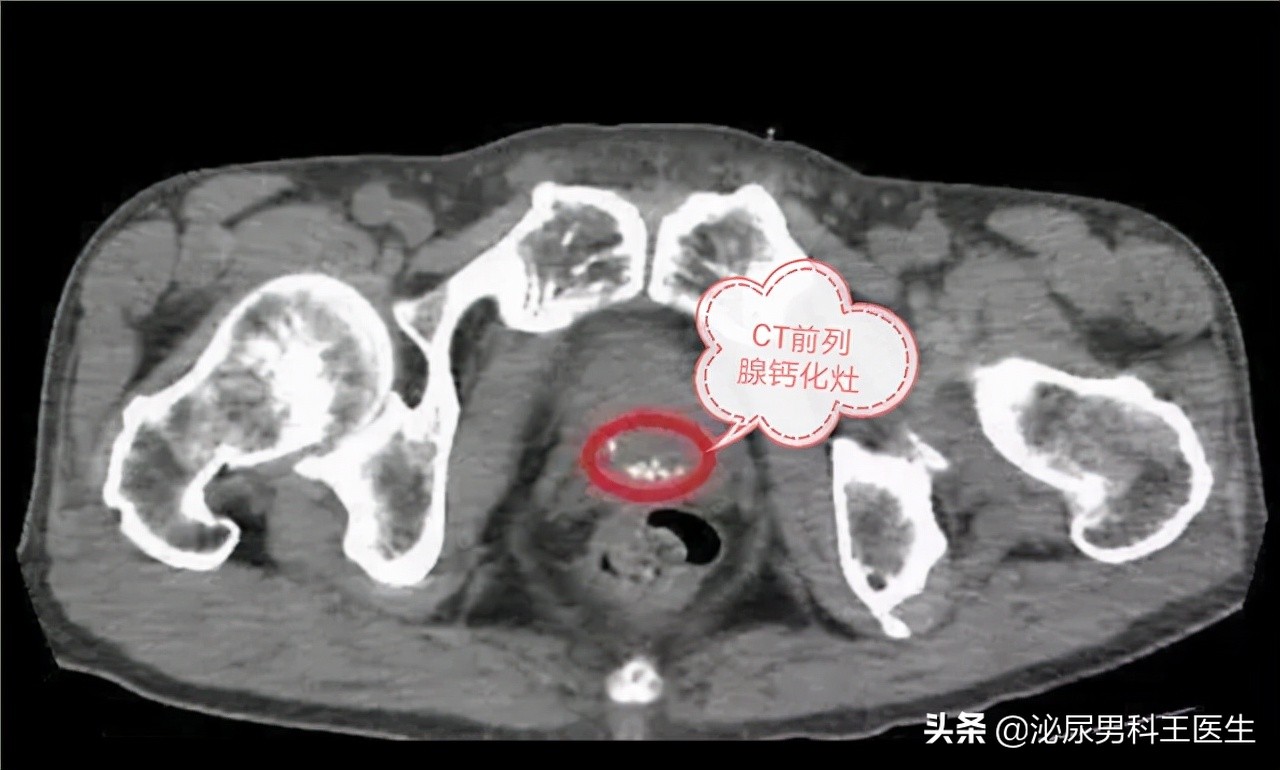 前列腺钙化对健康到底有没有影响？是否可以逆转治疗？